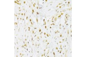 Immunohistochemistry of paraffin-embedded human gastric cancer using RBPJ Antibody (ABIN1876876) at dilution of 1:100 (40x lens). (RBPJ 抗体)