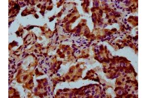 IHC image of ABIN7166751 diluted at 1:300 and staining in paraffin-embedded human lung cancer performed on a Leica BondTM system. (POU5F1B 抗体  (AA 10-138))