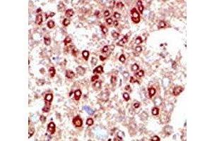 IHC testing of human hepatocarcinoma stained with SUMO2/3 antibody. (SUMO2/3 抗体  (AA 49-81))