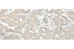 Immunohistochemistry of paraffin-embedded Human liver cancer tissue using HLA-DRB5 Polyclonal Antibody at dilution of 1:45(x200) (HLA-DRB5 抗体)