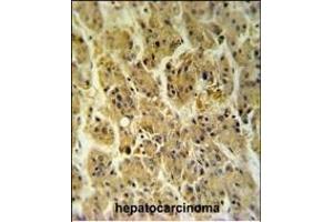 NDUFS2 Antibody (Center) (ABIN653726 and ABIN2843033) IHC analysis in formalin fixed and paraffin embedded hepatocarcinoma followed by peroxidase conjugation of the secondary antibody and DAB staining.