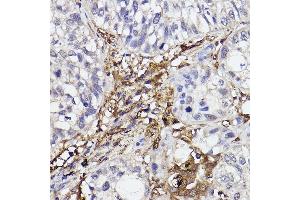Immunohistochemistry of paraffin-embedded human lung cancer using GBP1 Rabbit mAb (ABIN7267549) at dilution of 1:100 (40x lens). (GBP1 抗体)
