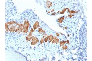 Formalin-fixed, paraffin-embedded human Breast Carcinoma stained with SM-MHC Recombinant Rabbit Monoclonal Antibody (MYH11/2303R). (Recombinant MYH11 抗体)