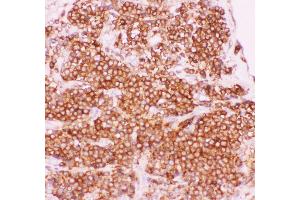 Anti-NFkB p105/P50 Picoband antibody,  IHC(P): Human Lung Cancer Tissue