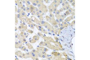 Immunohistochemistry of paraffin-embedded human liver injury using ABCB8 antibody at dilution of 1:100 (x40 lens). (ABCB8 抗体)
