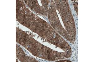 Immunohistochemical staining (Formalin-fixed paraffin-embedded sections) of human endometrium cancer with ASRGL1 monoclonal antibody, clone CL1679  shows strong immunoreactivity in tumor cells. (ASRGL1 抗体)