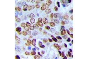 Immunohistochemical analysis of POLR3E staining in human prostate cancer formalin fixed paraffin embedded tissue section. (POLR3E 抗体)