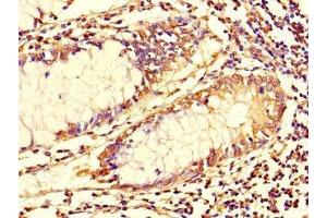 Immunohistochemistry of paraffin-embedded human colon cancer using ABIN7173699 at dilution of 1:100 (TUBG1 抗体  (AA 29-184))