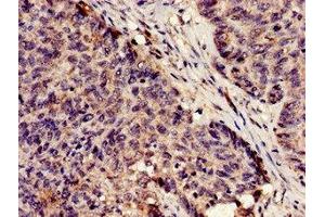Immunohistochemistry analysis of human ovarian cancer using ABIN7163528 at dilution of 1:100