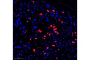 Immunofluorescence of paraffin embedded human gastric cancer using CD307 (ABIN7073931) at dilution of 1:1200 (300x lens) (FCRL5 抗体)
