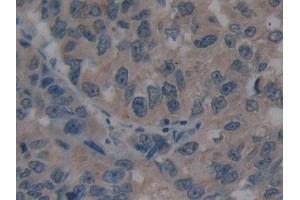 Detection of VIL in Human Breast cancer Tissue using Polyclonal Antibody to Villin (VIL)