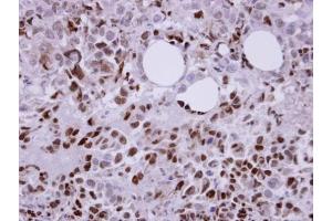 IHC-P Image Immunohistochemical analysis of paraffin-embedded CL1-0 xenograft, using Laforin, antibody at 1:100 dilution. (EPM2A 抗体  (C-Term))