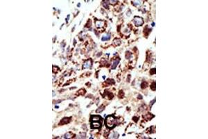 Formalin-fixed and paraffin-embedded human cancer tissue reacted with the primary antibody, which was peroxidase-conjugated to the secondary antibody, followed by AEC staining. (STAM 抗体  (C-Term))