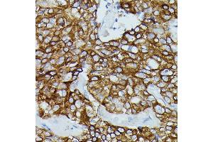 Immunohistochemistry of paraffin-embedded human mammary cancer using FCGR1B antibody (ABIN7267161) at dilution of 1:100 (40x lens). (FCGR1B 抗体)