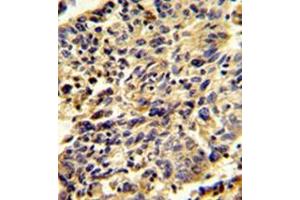 Immunohistochemistry analysis in formalin-fixed and paraffin-embedded human lung carcinoma reacted with Glypican-1 / GPC1Antibody (N-term) followed which was peroxidase-conjugated to the secondary antibody, followed by DAB staining. (GPC1 抗体  (N-Term))