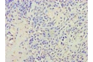 Immunohistochemistry of paraffin-embedded human breast cancer using ABIN7175416 at dilution of 1:100 (Vasopressin 抗体  (AA 126-164))