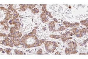 ABIN6272719 at 1/100 staining Human liver cancer tissue by IHC-P. (OR2B3 抗体  (Internal Region))
