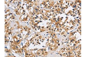 The image on the left is immunohistochemistry of paraffin-embedded Human thyroid cancer tissue using ABIN7191127(ITGA11 Antibody) at dilution 1/40, on the right is treated with synthetic peptide.