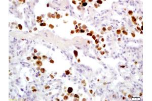 Formalin-fixed and paraffin embedded human lung carcinoma labeled with Anti-Granzyme B Polyclonal Antibody, Unconjugated (ABIN675354) at 1:200 followed by conjugation to the secondary antibody and DAB staining (GZMB 抗体  (AA 21-130))