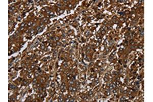 The image on the left is immunohistochemistry of paraffin-embedded Human liver cancer tissue using ABIN7191233(KLRF1 Antibody) at dilution 1/30, on the right is treated with synthetic peptide. (KLRF1 抗体)
