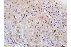 Formalin-fixed and paraffin embedded human laryngeal carcinoma labeled with Anti Phospho-cdc2 (Tyr15) Polyclonal Antibody, Unconjugated (ABIN684013) at 1:200 followed by conjugation to the secondary antibody and DAB staining (CDK1 抗体  (pTyr15))