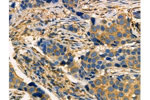 Phospho-MAP4K4 (Ser801) Antibody at 1/100 staining Human breast cancer by IHC-P. (MAP4K4 抗体  (pSer801))