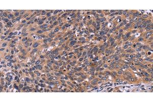 Immunohistochemistry of paraffin-embedded Human cervical cancer tissue using SPATA7 Polyclonal Antibody at dilution 1:30 (SPATA7 抗体)