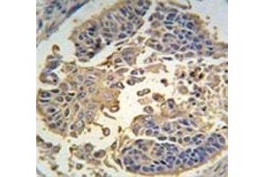 IHC analysis of FFPE human lung carcinoma tissue stained with RIPK3 antibody (RIPK3 抗体  (AA 489-518))