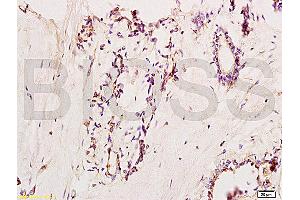 Formalin-fixed and paraffin embedded human breast carcinoma labeled with Anti-VCAM-1/CD106/L1CAM Polyclonal Antibody, Unconjugated (ABIN729838) at 1:200, followed by conjugation to the secondary antibody and DAB staining (VCAM1 抗体  (AA 651-739))