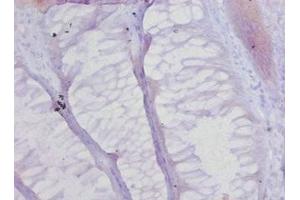 Immunohistochemistry of paraffin-embedded human colon cancer using ABIN7148231 at dilution of 1:20 (COL17A1 抗体  (AA 1253-1497))