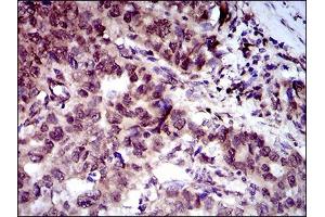 Immunohistochemical analysis of paraffin-embedded esophageal cancer tissues using CLGN mouse mAb with DAB staining. (Calmegin 抗体  (AA 249-405))