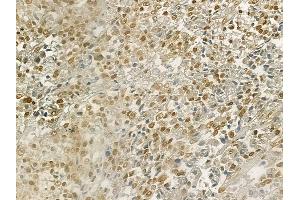 ABIN6265989 and ABIN6269137 at 1/100 staining human prostate carcinoma by IHC-P. (Vitamin D Receptor 抗体  (Internal Region))