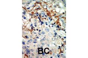 Formalin-fixed and paraffin-embedded human cancer tissue reacted with EPHA3 polyclonal antibody  , which was peroxidase-conjugated to the secondary antibody, followed by AEC staining. (EPH Receptor A3 抗体  (N-Term))