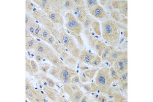 Immunohistochemistry of paraffin-embedded human liver cancer using BLVRB antibody.