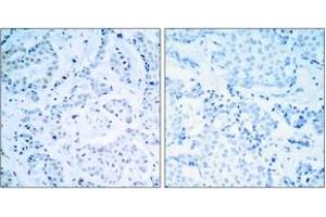 Immunohistochemistry analysis of paraffin-embedded human breast carcinoma tissue, using Estrogen Receptor-alpha (Ab-104) Antibody. (Estrogen Receptor alpha 抗体  (AA 81-130))