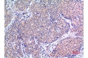 Immunohistochemistry (IHC) analysis of paraffin-embedded Human Mammary Cancer, antibody was diluted at 1:100. (VGF 抗体  (Internal Region))