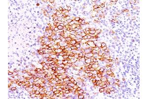 Formalin-fixed, paraffin-embedded human Hodgkin's lymphoma stained with CD30 Ab (CD30/412). (TNFRSF8 抗体)