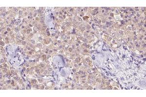 ABIN6273344 at 1/100 staining Human thyroid cancer tissue by IHC-P. (VPS11 抗体  (Internal Region))