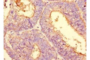 Immunohistochemistry of paraffin-embedded human melanoma using ABIN7163728 at dilution of 1:200 (PODXL 抗体)