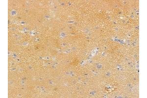 ABIN6255270 and ABIN6267406 at 1/100 staining human glioblastoma by IHC-P. (Stathmin 1 抗体  (pSer38))