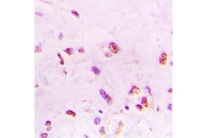 Immunohistochemical analysis of Ku70 staining in human lung cancer formalin fixed paraffin embedded tissue section. (XRCC6 抗体  (C-Term))