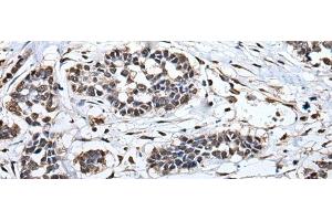 Immunohistochemistry of paraffin-embedded Human esophagus cancer tissue using HNRNPH2 Polyclonal Antibody at dilution of 1:40(x200) (HNRNPH2 抗体)