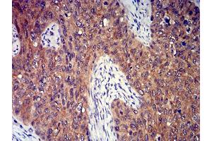 Immunohistochemical analysis of paraffin-embedded cervical cancer tissues using P2RY8 mouse mAb with DAB staining. (P2RY8 抗体)