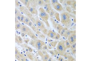 Immunohistochemistry of paraffin-embedded human liver cancer using BLVRB antibody at dilution of 1:100 (40x lens). (BLVRB 抗体)
