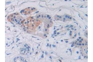 Detection of SUMF1 in Human Prostate cancer Tissue using Polyclonal Antibody to Sulfatase Modifying Factor 1 (SUMF1) (SUMF1 抗体  (AA 113-356))