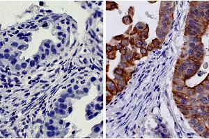 Paraffin embedded human gastric cancer tissue was stained with Mouse IgG2b-HRP isotype control followed by DAB and hematoxylin. (Cytokeratin 18 抗体  (HRP))