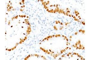 Formalin-fixed, paraffin-embedded human lung Adenocarcinoma stained with TTF1 antibody (NX2. (TTF1 抗体)