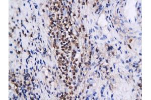Formalin-fixed and paraffin embedded cervical intraepithelial xenografts labeled with Anti-Annexin A1 Polyclonal Antibody, unconjugated  (ABIN731378)  followed by incubation with conjugated secondary antibody and DAB staining (Annexin a1 抗体  (AA 281-346))