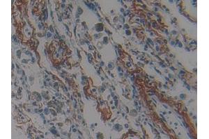 DAB staining on IHC-P; Samples: Human Lung cancer Tissue (Nischarin 抗体  (AA 1246-1346))