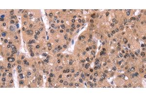 Immunohistochemistry of paraffin-embedded Human liver cancer using ARC Polyclonal Antibody at dilution of 1:50 (ARC 抗体)